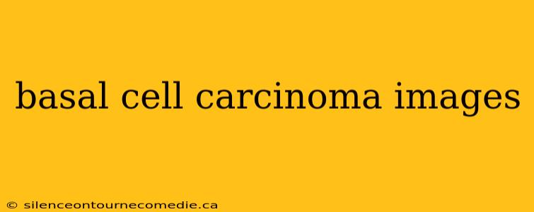 basal cell carcinoma images