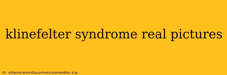 klinefelter syndrome real pictures