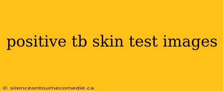 positive tb skin test images